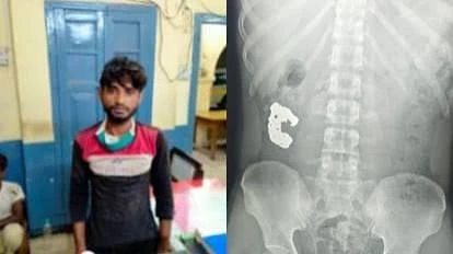 चोर ने पुलिस से बचने के लिए निगला ब्रेसलेट, अब अस्पताल में चल रही निगरानी